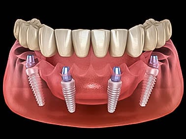 diagram showing how dental implants are placed
