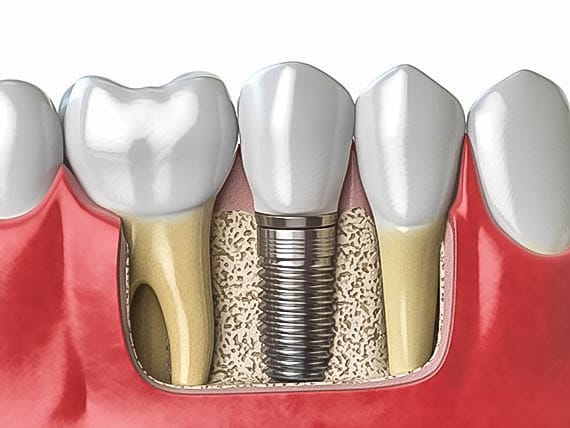 metal dental implants