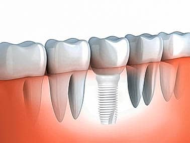 metal free dental implant installed