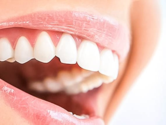 up close of patients mouth with a chipped tooth