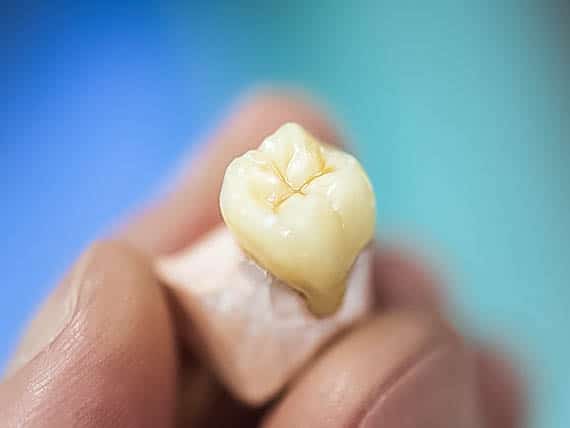 model of a tooth crown