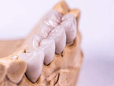 model of what a bridge for teeth looks like