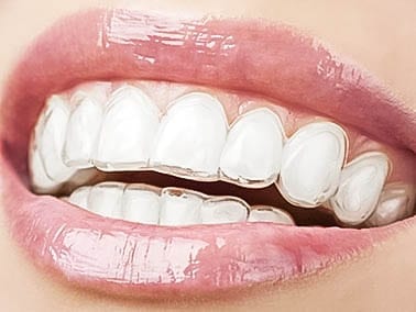 dental patient with Invisalign installed