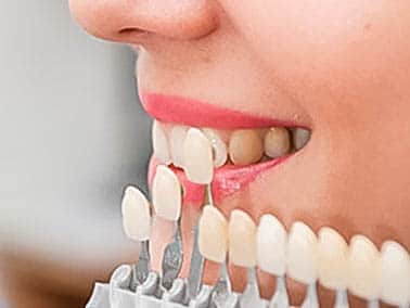 dentist testing different veneers on patient