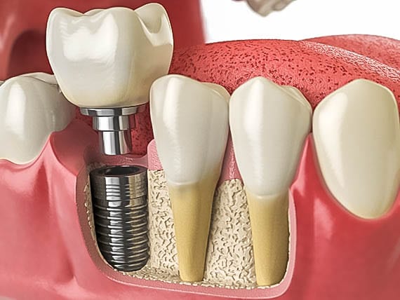 diagram of a dental implant