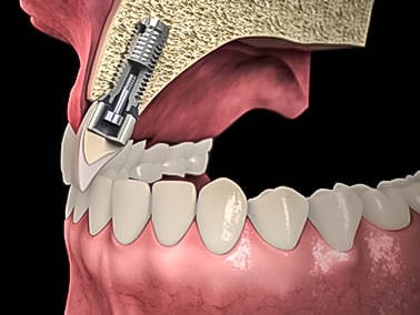 diagram of how a dental implant is screwed into the bone